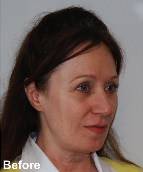 Facelift Before & After Gallery - Patient 245710 - Image 3