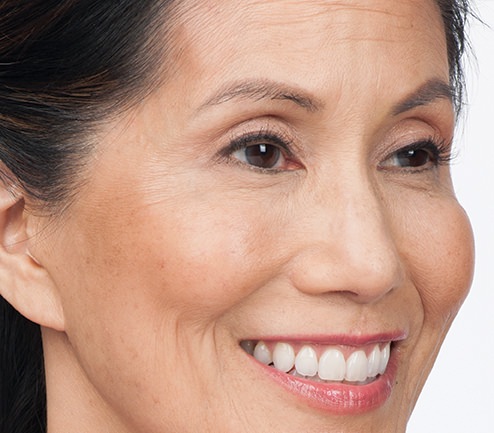 BOTOX® Before & After Gallery - Patient 264984 - Image 4