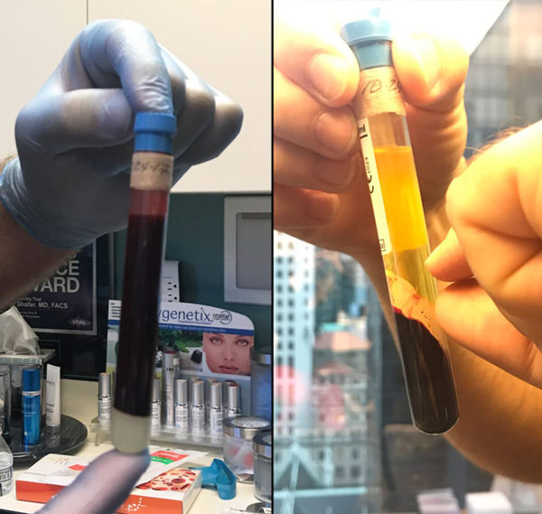 blood drawn and spun for PRP microneedling