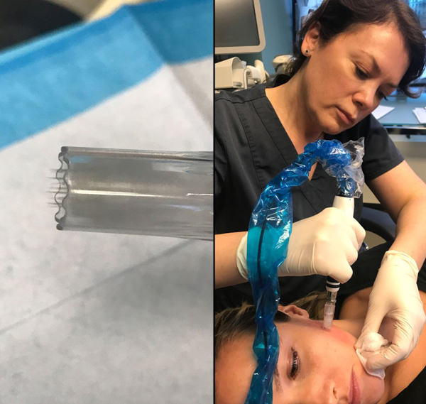 woman getting PRP microneedling